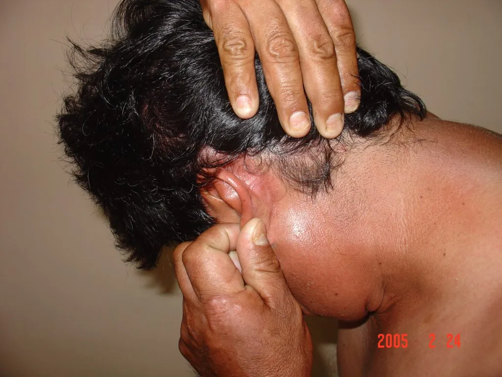 Imagen de Ahora cuero cabelludo 1 relacionada con el tratamiento de psoriasis