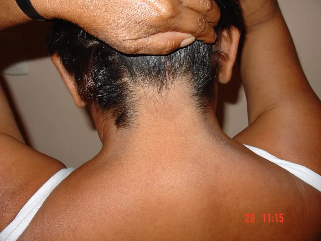 Imagen de Ahora cuero cabelludo 2 relacionada con el tratamiento de psoriasis
