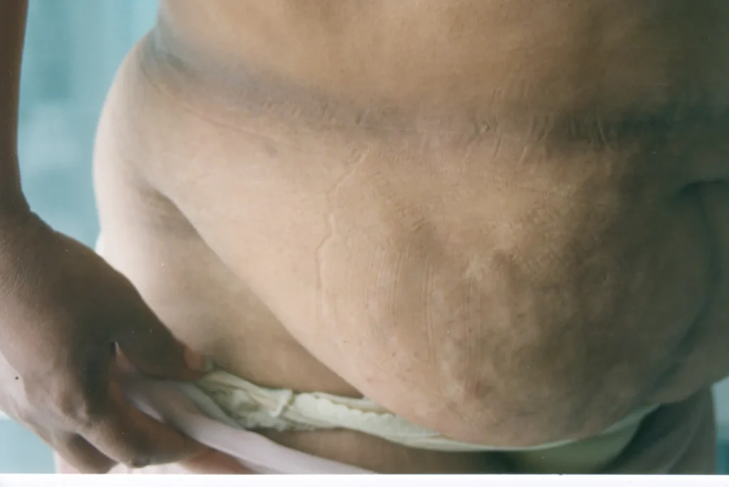 Imagen de Ahora gotas 1 relacionada con el tratamiento de psoriasis