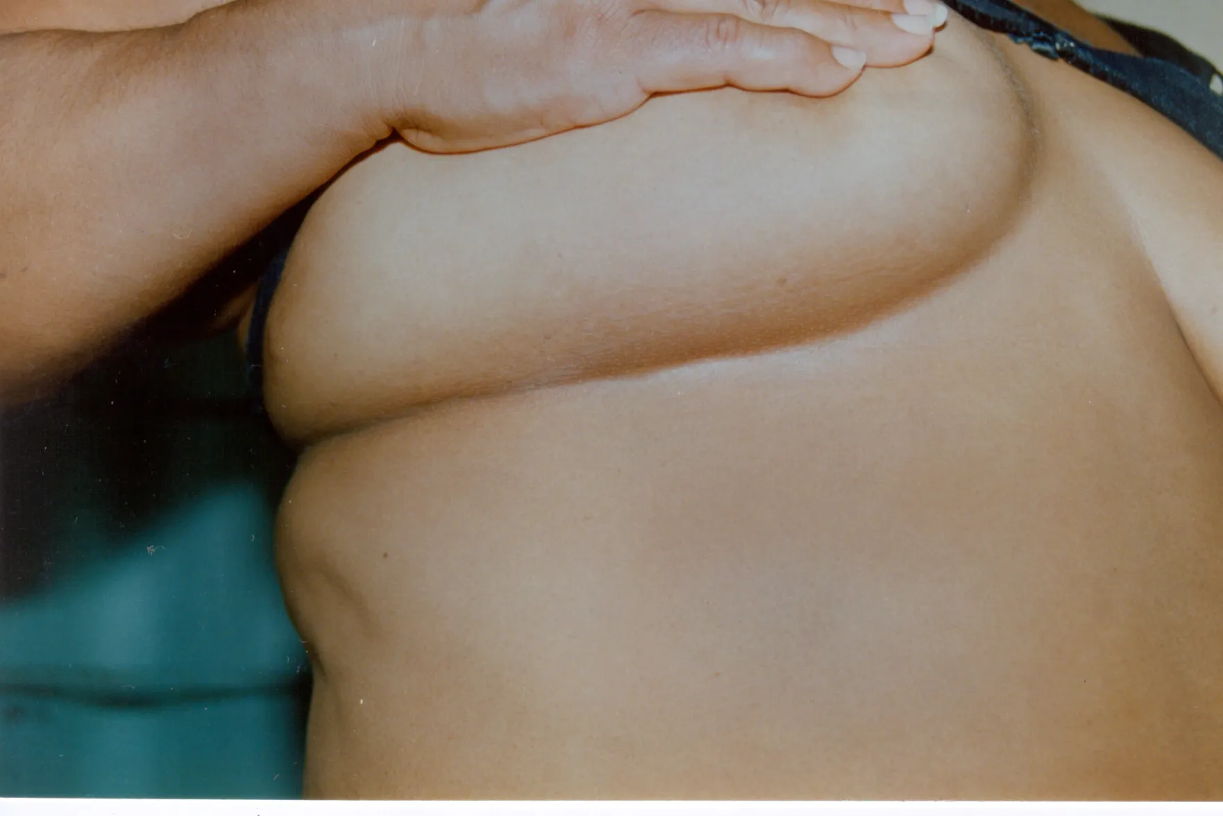 Imagen de Ahora gotas 3 relacionada con el tratamiento de psoriasis