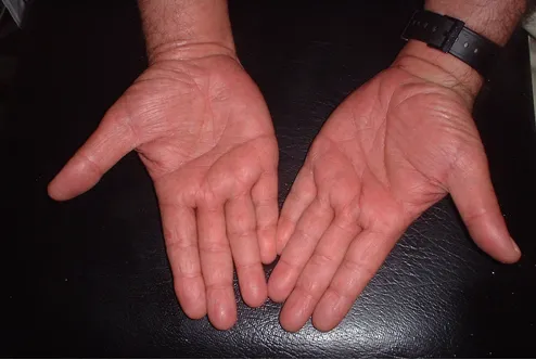Imagen de Ahora manos 1 relacionada con el tratamiento de psoriasis