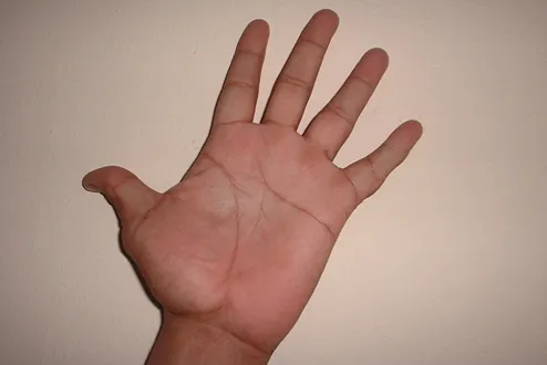 Imagen de Ahora manos 3 relacionada con el tratamiento de psoriasis