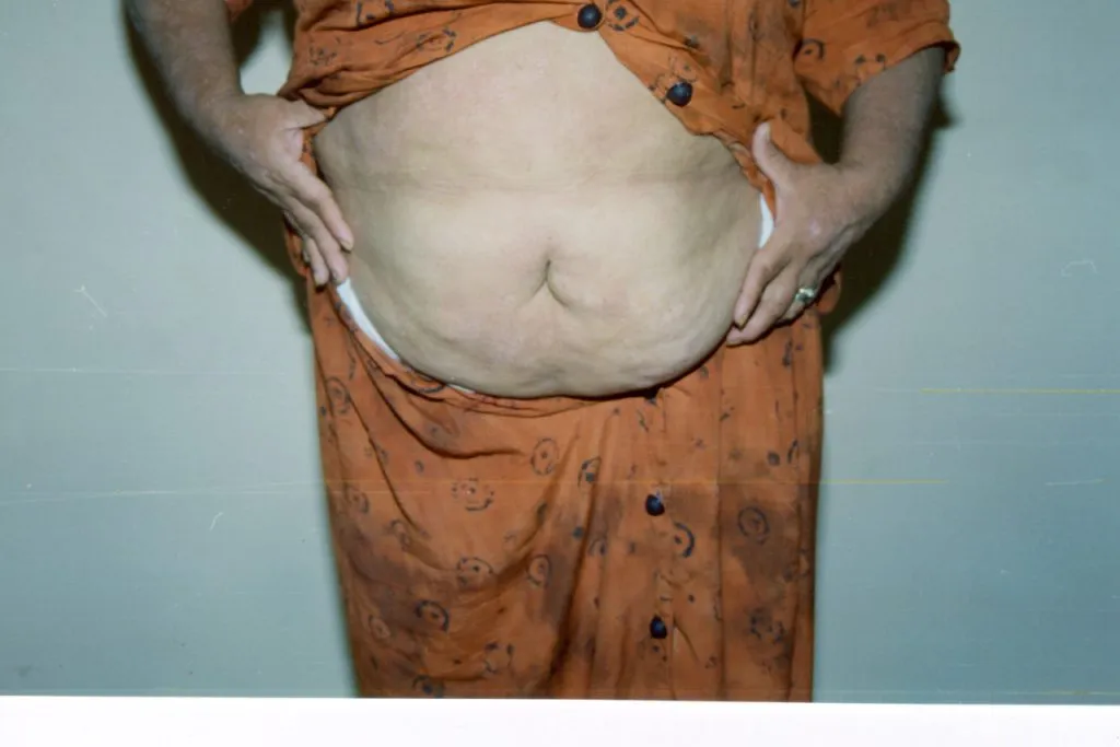 Imagen de Ahora placas 2 relacionada con el tratamiento de psoriasis