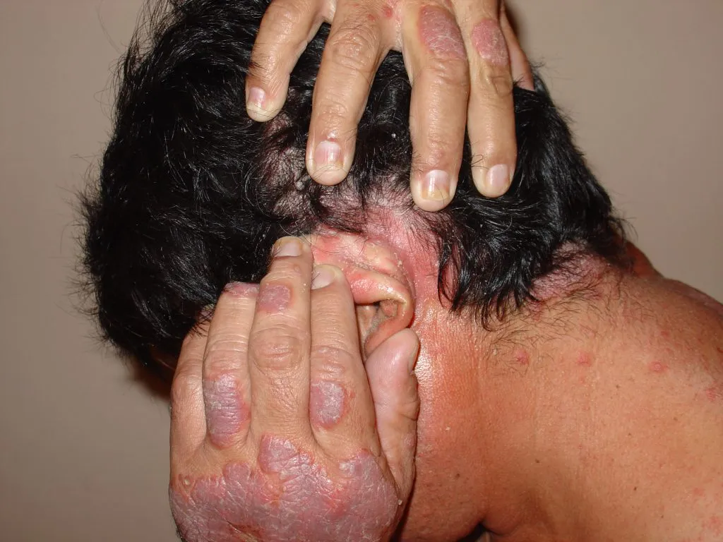 Imagen de Antes cuero cabelludo 1 relacionada con el tratamiento de psoriasis