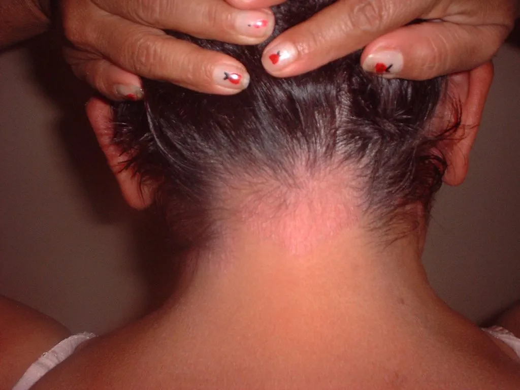 Imagen de Antes cuero cabelludo 2 relacionada con el tratamiento de psoriasis