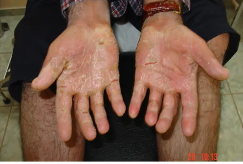 Imagen de Antes manos 1 relacionada con el tratamiento de psoriasis