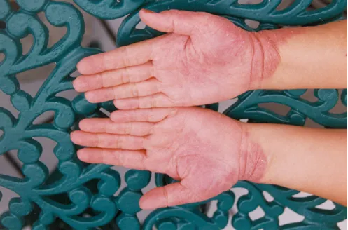 Imagen de Antes manos 2 relacionada con el tratamiento de psoriasis