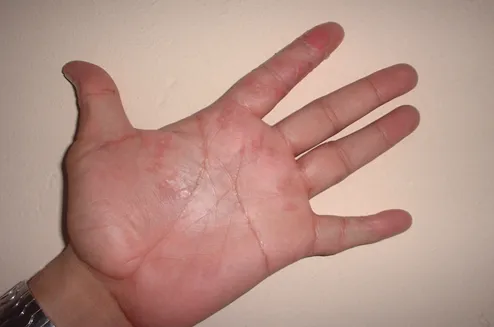 Imagen de Antes manos 3 relacionada con el tratamiento de psoriasis