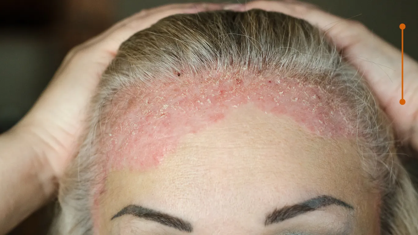 Imagen de Cara relacionada con el tratamiento de psoriasis