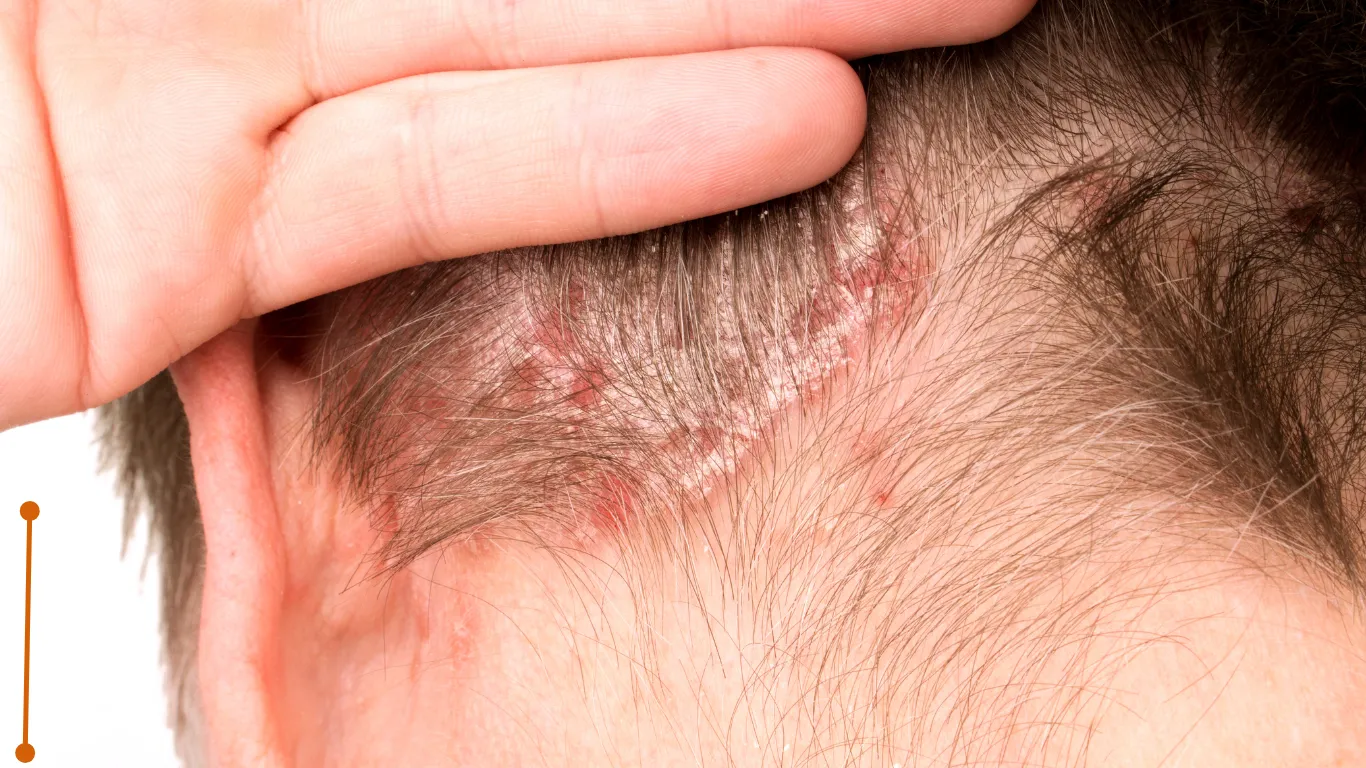 Imagen de Cuero cabelludo relacionada con el tratamiento de psoriasis