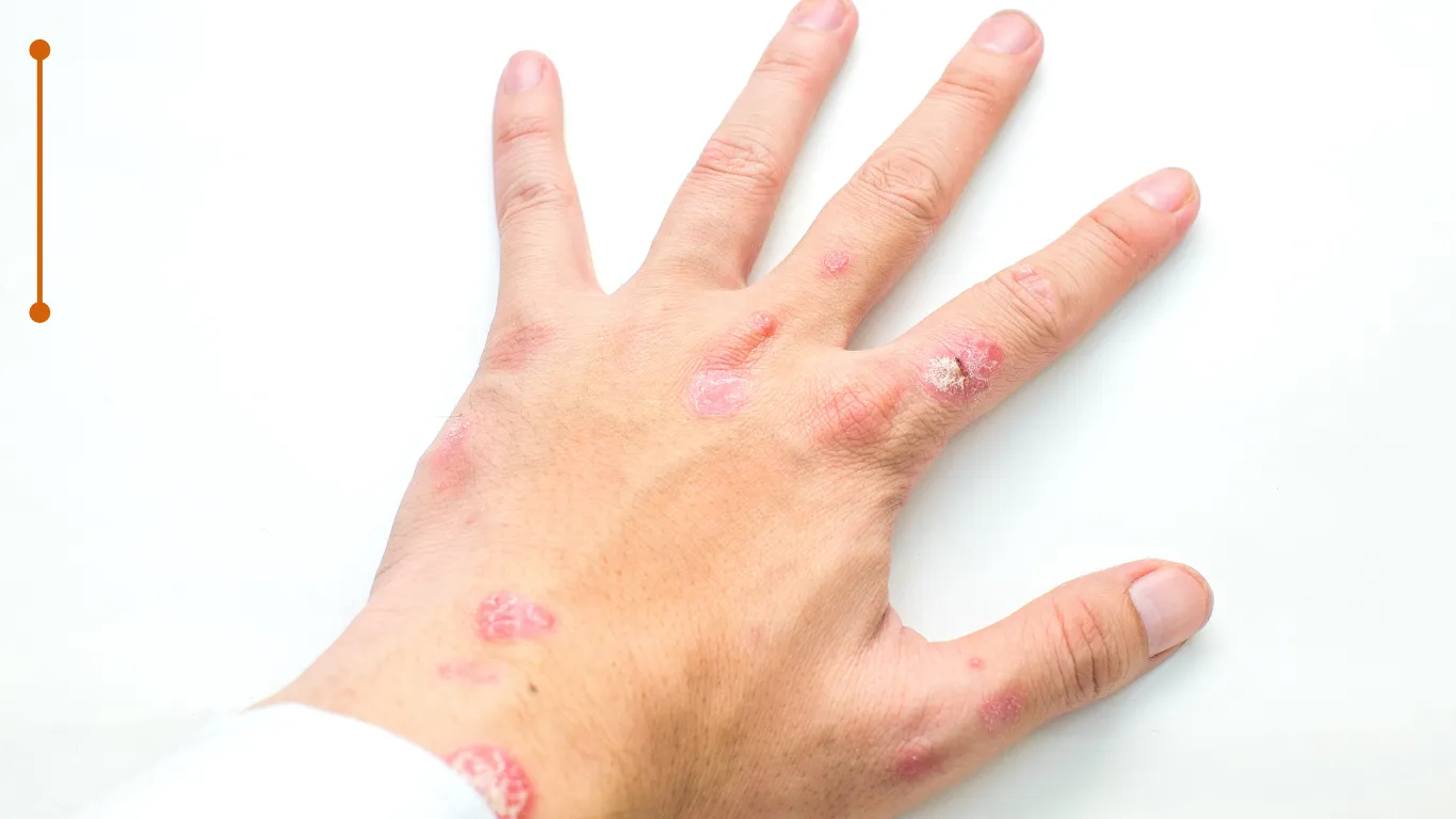 Imagen de Manos y pies relacionada con el tratamiento de psoriasis