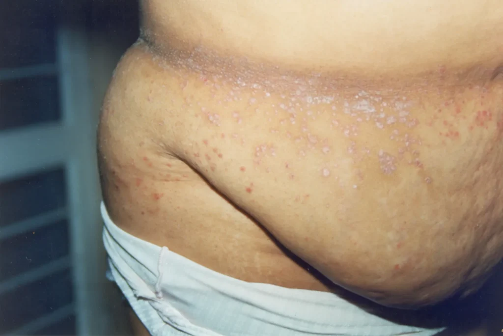 Imagen de Psoariasis en gotas 1 relacionada con el tratamiento de psoriasis