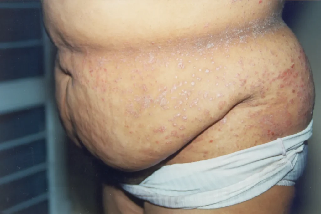 Imagen de Psoariasis en gotas 2 relacionada con el tratamiento de psoriasis