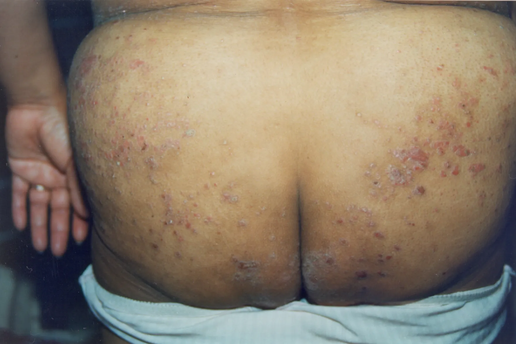 Imagen de Psoariasis en gotas 3 relacionada con el tratamiento de psoriasis