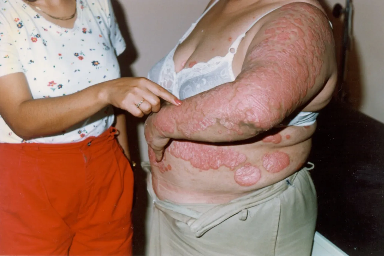 Imagen de Psoriasis de placas 3 relacionada con el tratamiento de psoriasis